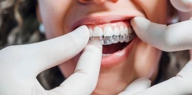 Nakładki ortodontyczne na zęby - wygodna alternatywa dla aparatu