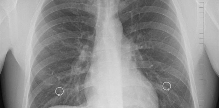 Zapalenie płuc - leczenie i powikłania